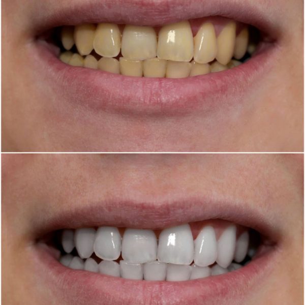 Before And After Teeth Whitening