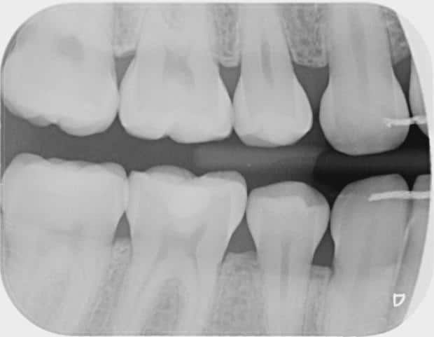 New Patient Bitewing Dental X-Ray of a Kid from Toowoomba QLD