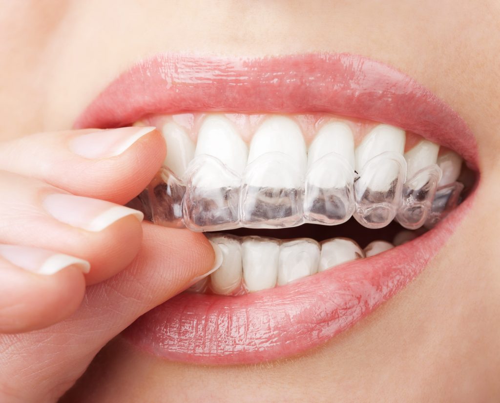 Clear Invisalign Wear on Upper Teeth | Invisalign on Toowoomba QLD