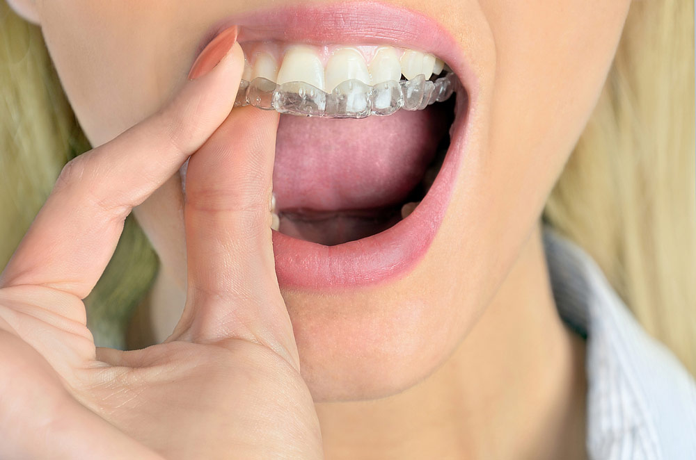 Woman Put Retainers On Teeth